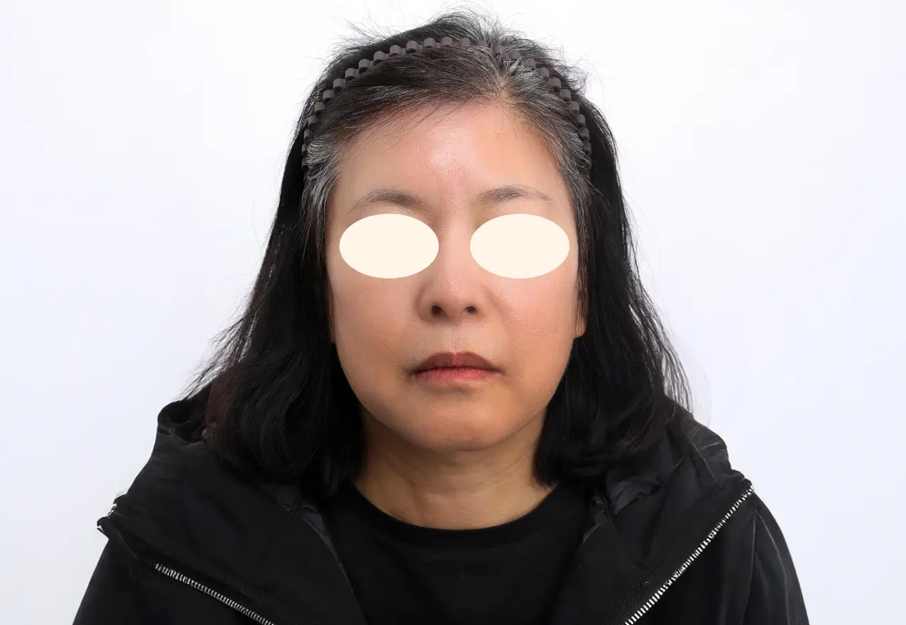 모공 축소 시술 후
